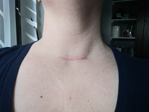 neck scar 3 months
